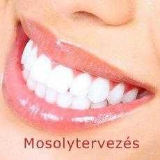 Mosolytervezés - Smile Design